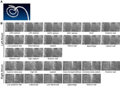 Atrial fibrillation activation patterns predict freedom from arrhythmias after catheter ablation: utility of ExTRa mapping™